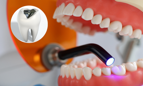 Dental Filling in Udumalpet