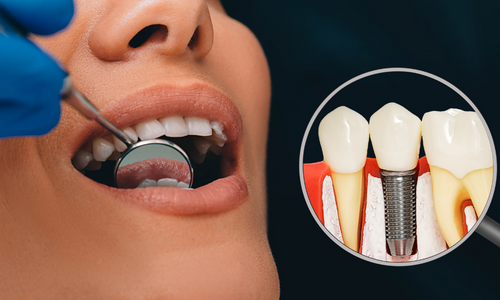 Dental Implants in Udumalpet