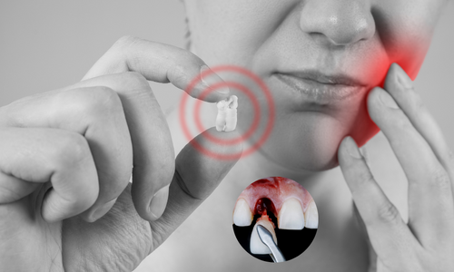 Dental Impaction in Udumalpet